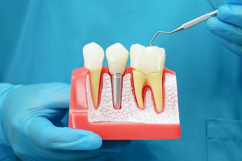 austin dental implants